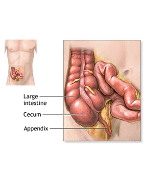 Appendicitis