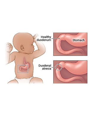 Duodenal Atresia