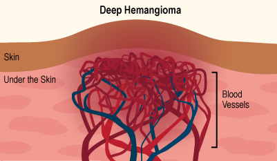 Haemangiomas