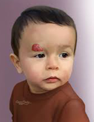 Haemangiomas