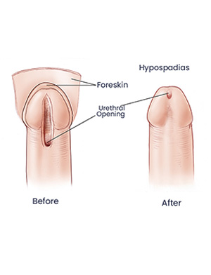 Hypospadias Surgery