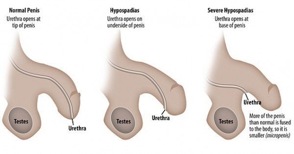 Hypospadias Surgery