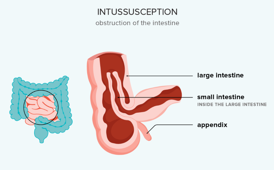 Intussusception