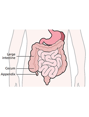 Intussusception