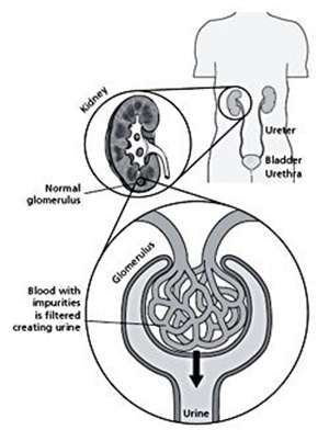 Kidney Stones