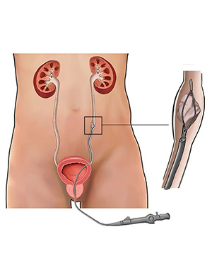 Kidney Stones