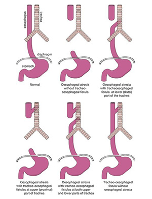 Oesophageal Atresia