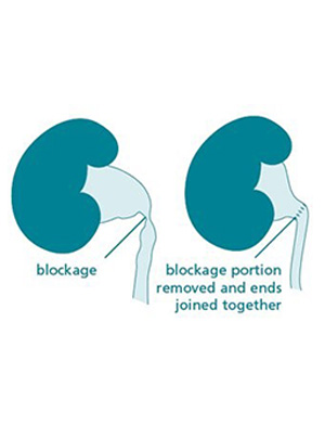 Pyeloplasty for Pelviureteric Junction Obstruction