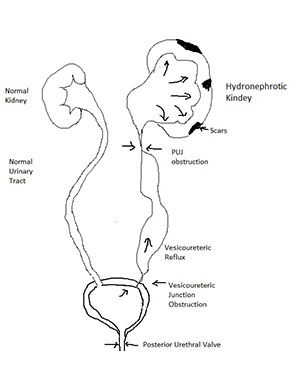 Vesicoureteric Reflux & VUJ Obstruction Treatment Ureteric Reimplantation